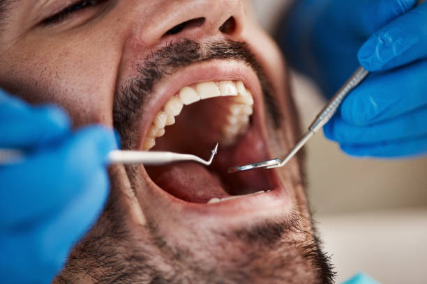 Best Emergency Wisdom Teeth Removal in Vidalia, LA